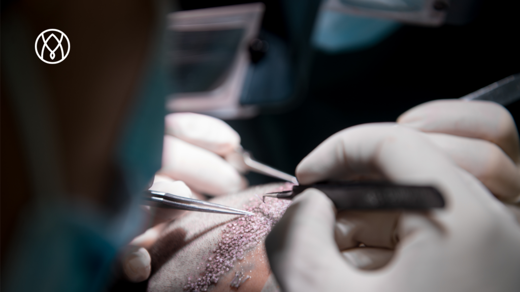 Métodos de implantación en trasplante capilar: injerto capilar usando pinzas. 